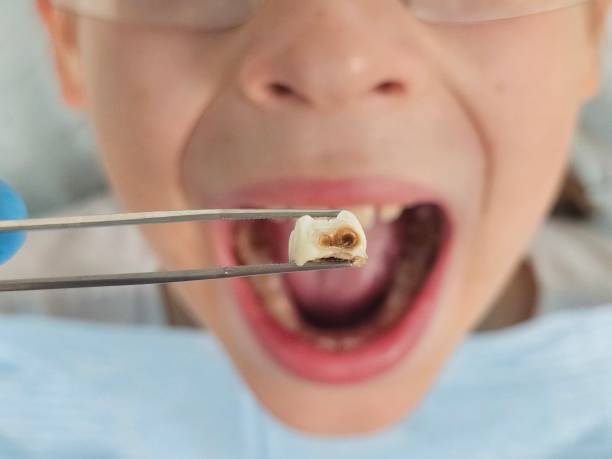 Best Emergency Tooth Extraction in Charlotte, TX